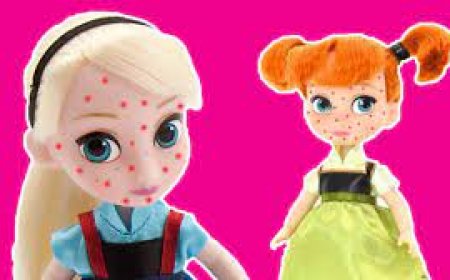 Chicken Pox for Kids
