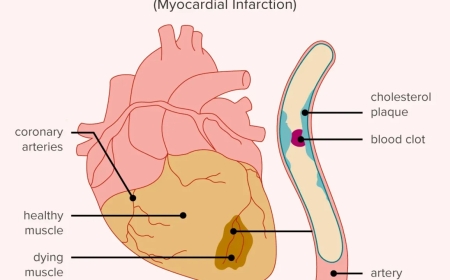 Introduction To Heart Attack For Kids