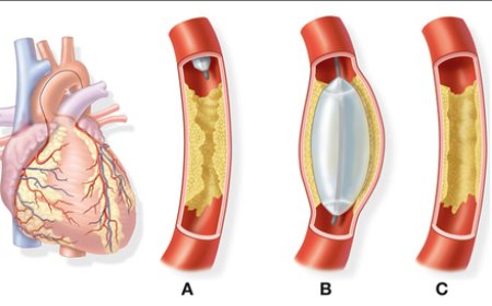 Angiography