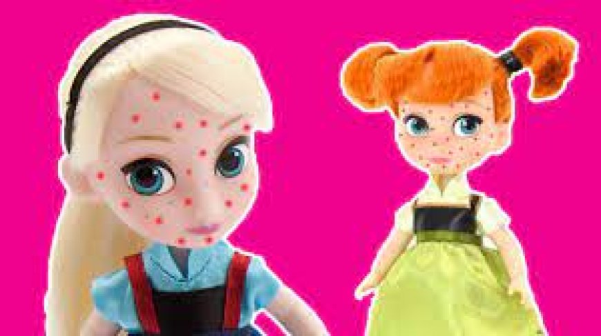 Chicken Pox for Kids