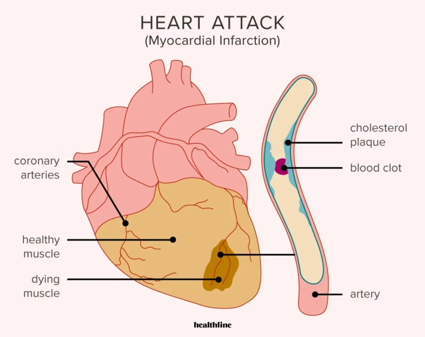 Introduction To Heart Attack For Kids