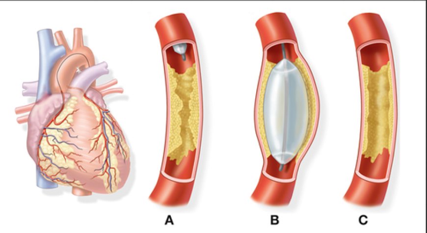 Angiography