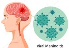 Viral meningitis
