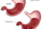 Ulcer - Peptic