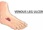 Venous skin ulcers