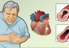 Unstable Angina