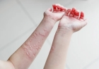 Urticaria