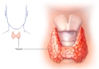 Underactive Thyroid (Hypothyroidism)