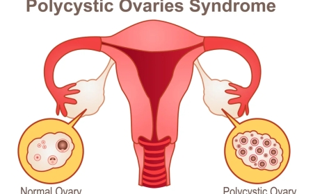 Bilateral Polycystic Ovarian Syndrome