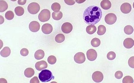 Folate Deficiency Anemia- Rare Types of Anemia