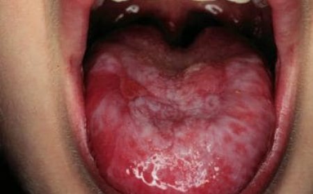 Idiopathic Aplastic anemia