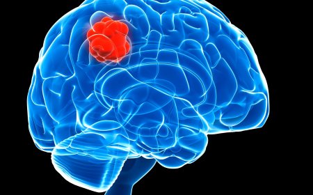 Brain tumor