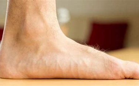 Flatfoot (Pes Planus)