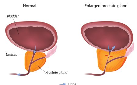 Benign Prostatic Enlargement( BPH)