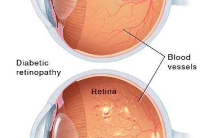 Diabetic Retinopathy