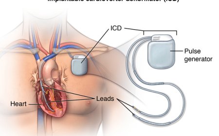 Implantable Cardioverter Defibrillator ICD