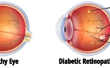 Diabetic Eye Disease