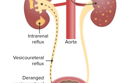 Bladder Infections in Children