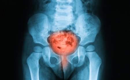 Bladder cancer