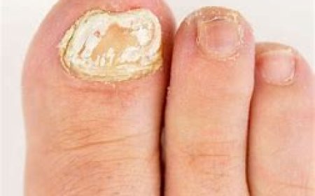 Fungal Nail Infection
