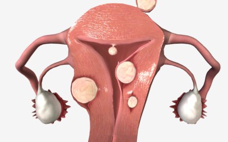 Dysfunctional Uterine Bleeding
