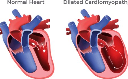 Idiopathic Dilated Cardiomyopathy