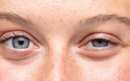 Drooping Eyelids (Ptosis)
