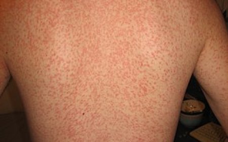 Infectious mononucleosis (IM)