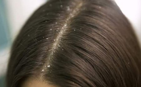 Dandruff