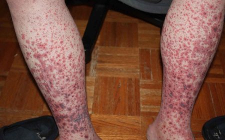 ITP ( Immune Throbocytopenia)