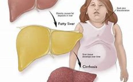 Non-Alcoholic Fatty Liver Disease