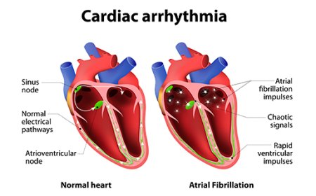 Arrhythmia
