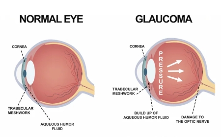 Glaucoma