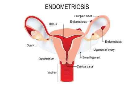 Hormone therapy for endometriosis