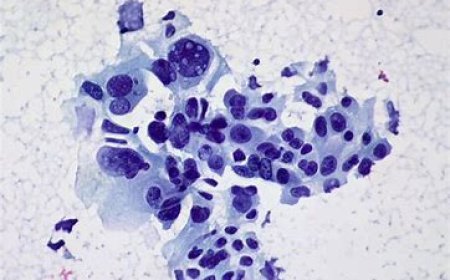 Non-Small-Cell Lung Cancer