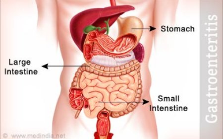 Gastroenteritis