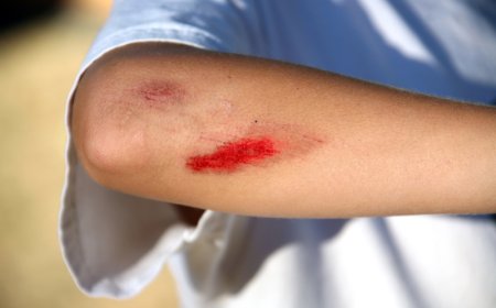 How to Stop Bleeding From a Minor Head Wound