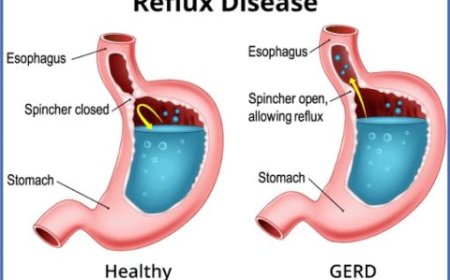 GERD (Gastroesophageal reflux disease)