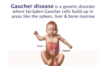 Gaucher Disease