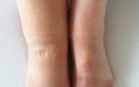 Lymphedema
