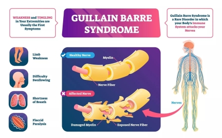 Guillain-Barre Syndrome
