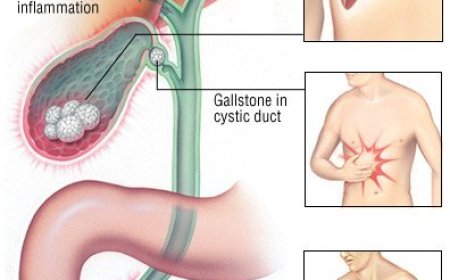 Gallbladder Inflammation