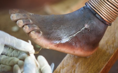 Guinea Worm Infection