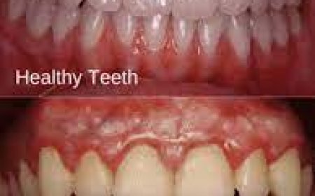 Gum Disease (Periodontitis)