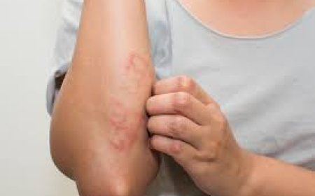 Eczema