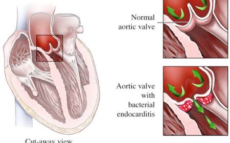 Endocarditis
