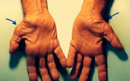 Carpal Tunnel Syndrome