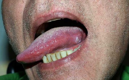 Cancer of Tongue