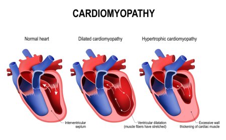Cardiomyopathy