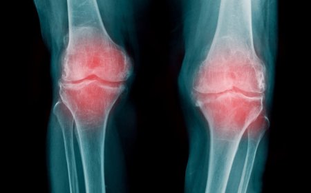 Kneecap disorder